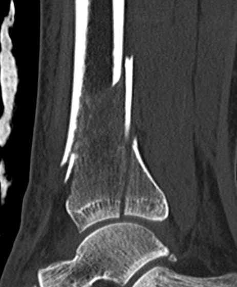 Distal tibia plate 3